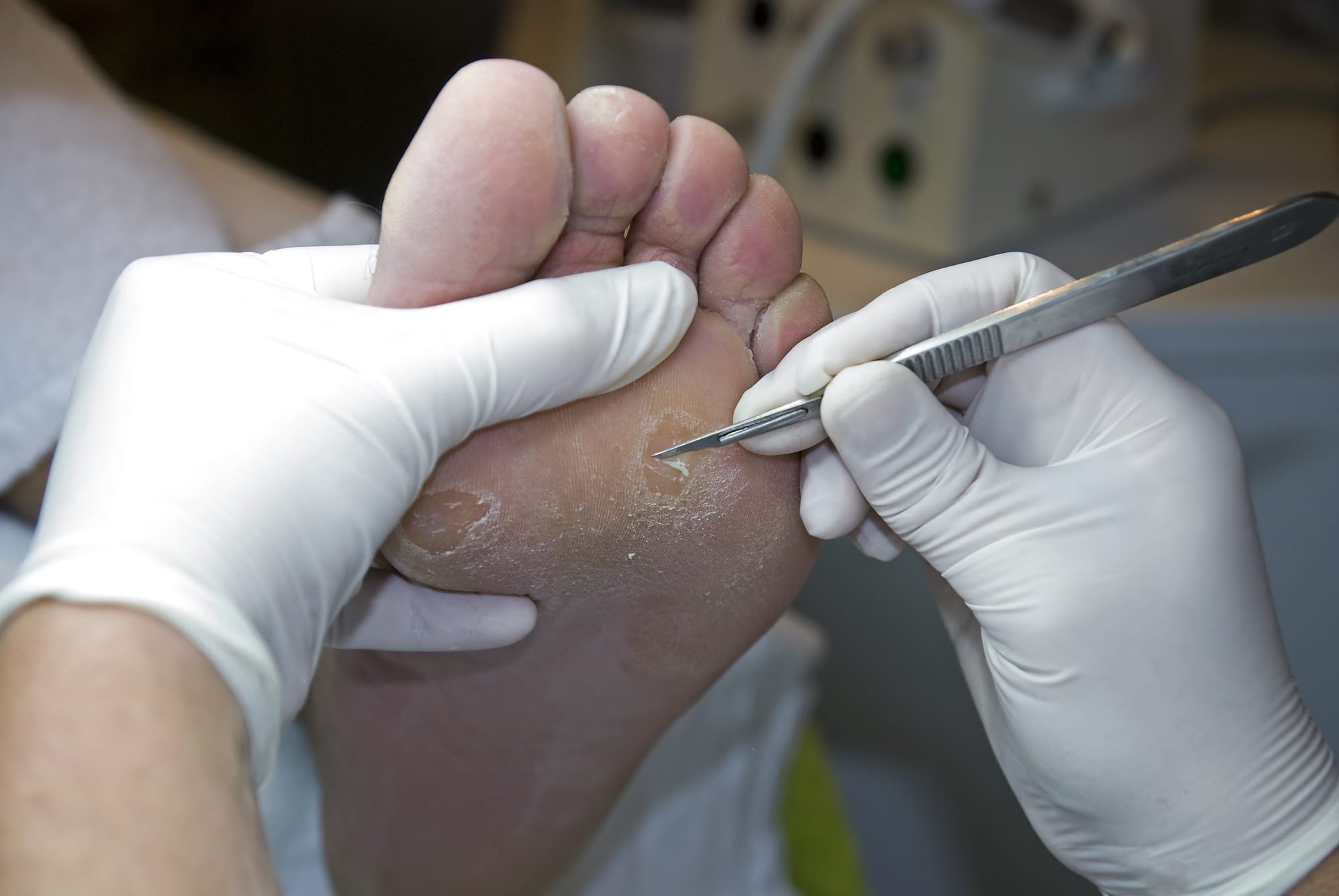 do-foot-corns-have-roots-podiatry-miami